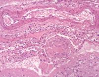 Pinks swirls showing perivascular inflammation libien.